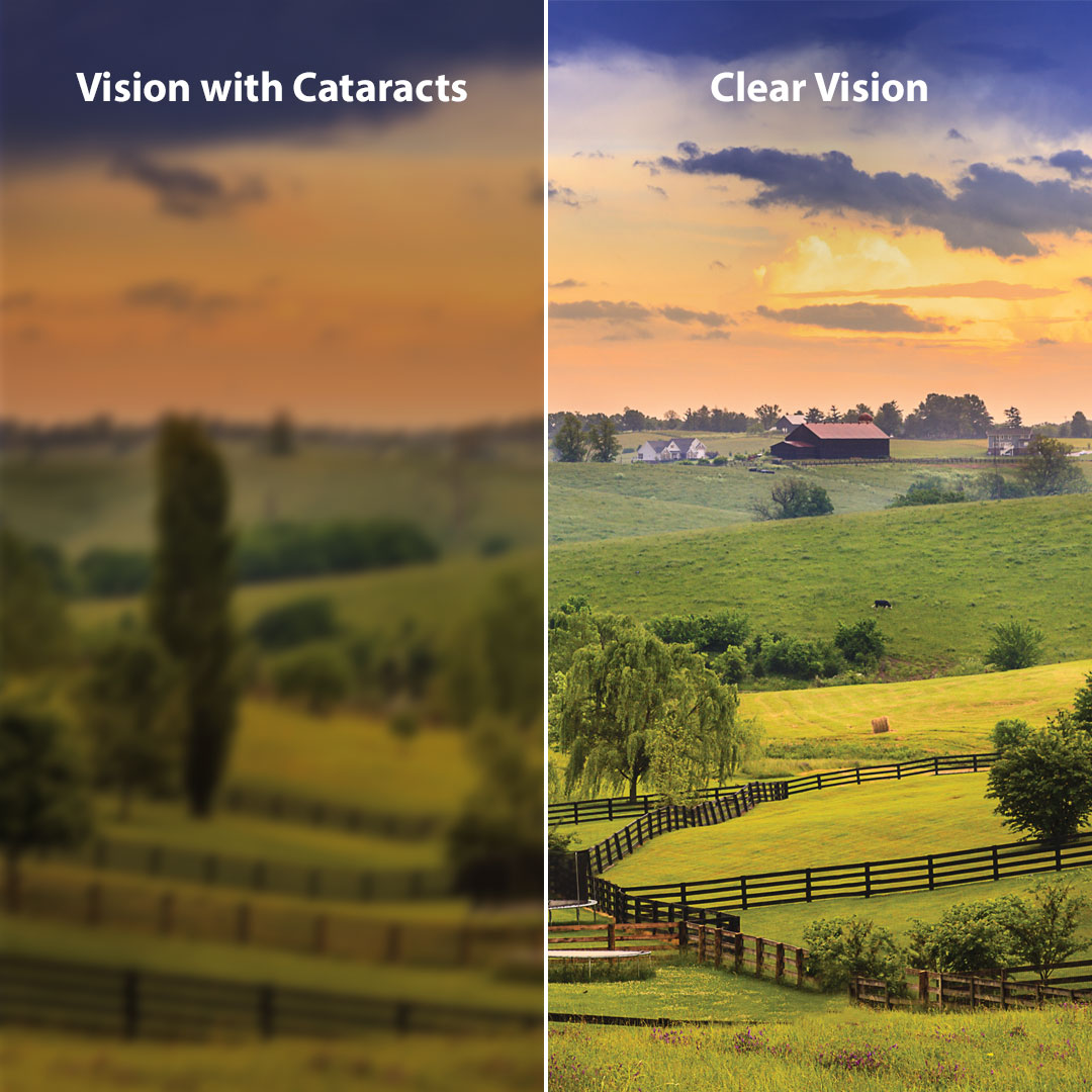 Cataracts Commonwealth Eye Surgery